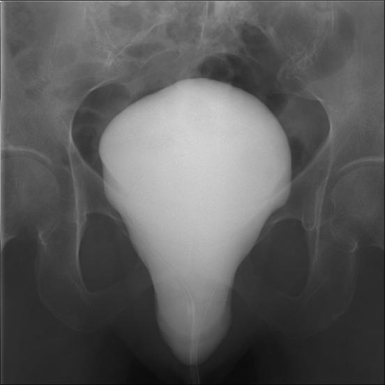 severe bladder prolapse cystometrogram serag youssif